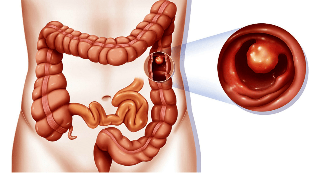 中醫(yī)胃腸肛門病科丨肛腸疾病不用愁，每周日中醫(yī)肛腸主任為您提供一站式治療方案